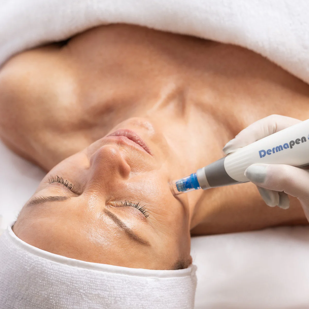 dermapen tedavisi