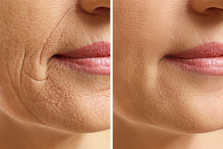 Marionette Dolgu 1 marionette dolgu istanbul oncesi sonrasi2